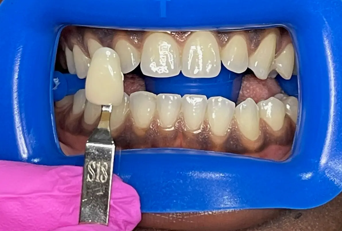 Inside Teeth Whitening Bedazzled.ByYasz, Near Southside, Fort Worth